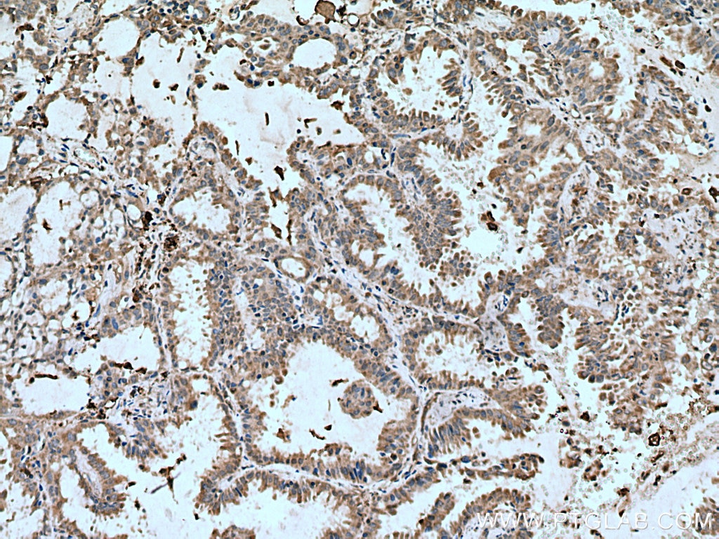 Immunohistochemistry (IHC) staining of human lung cancer tissue using VAMP5 Polyclonal antibody (11822-1-AP)