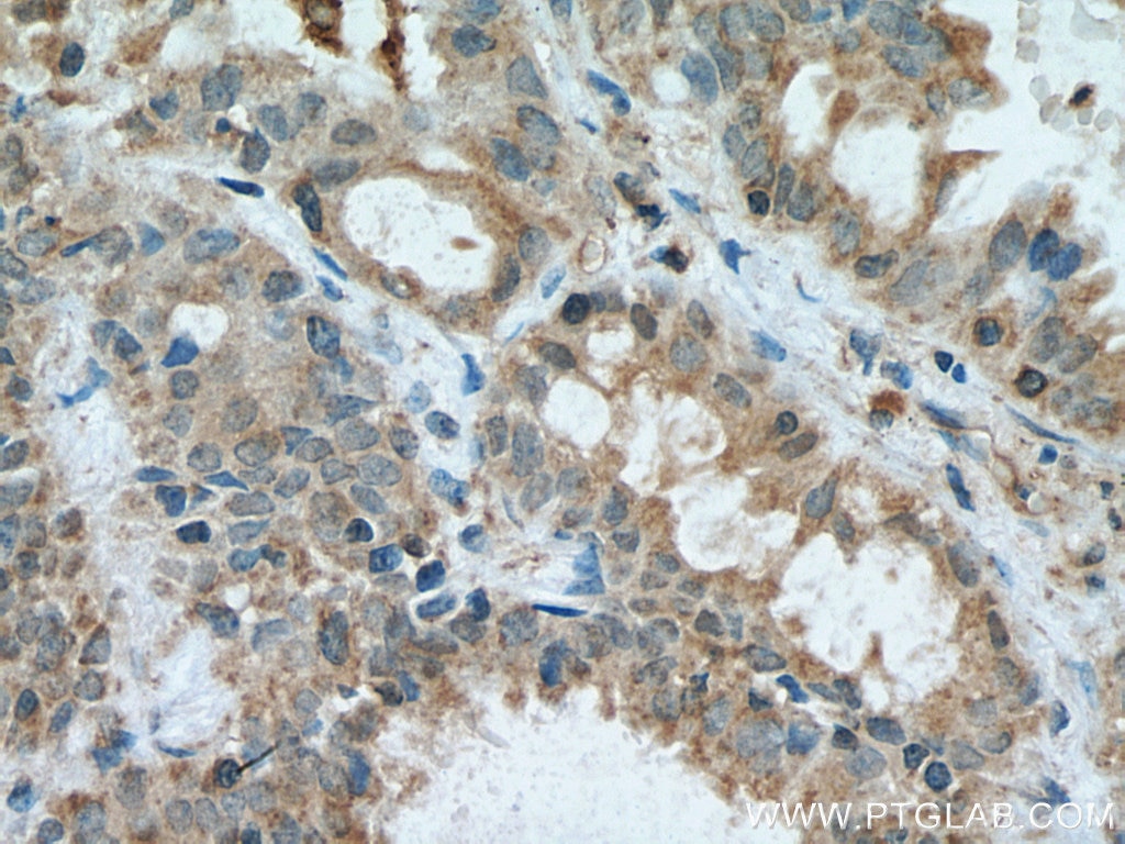 Immunohistochemistry (IHC) staining of human lung cancer tissue using VAMP5 Polyclonal antibody (11822-1-AP)
