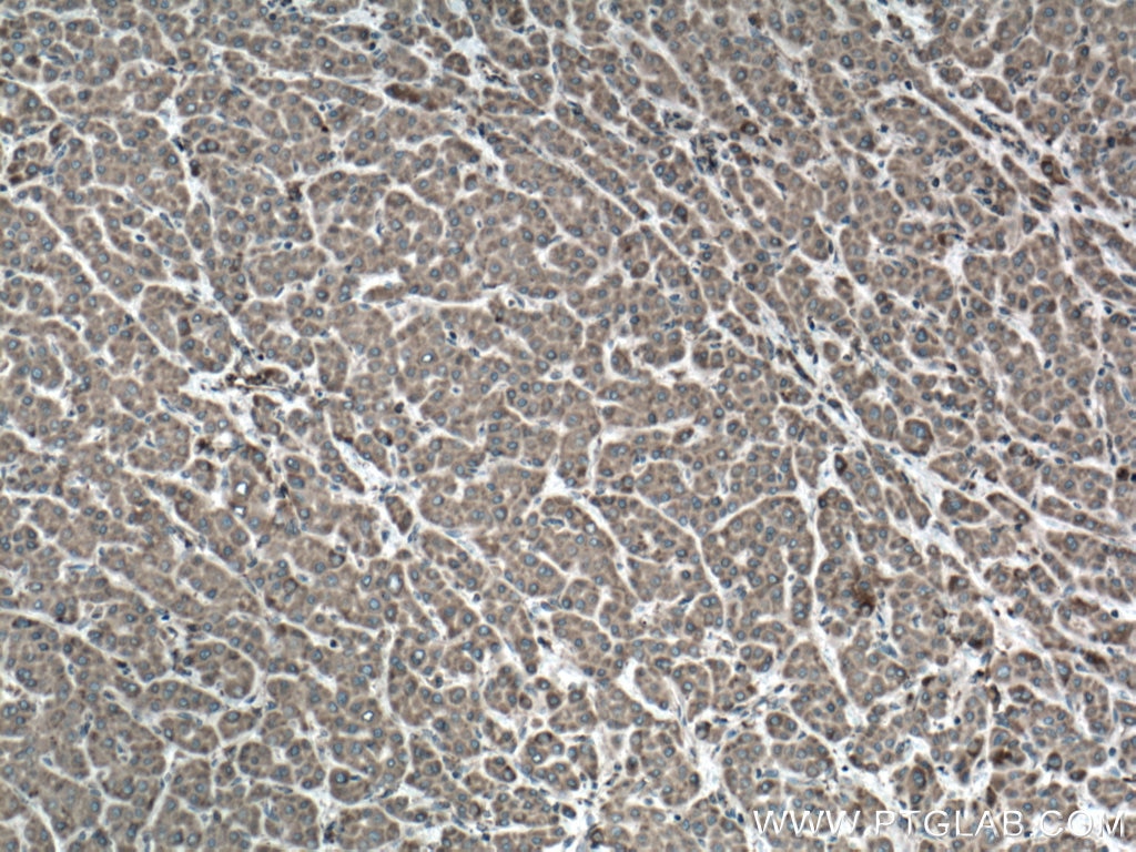 Immunohistochemistry (IHC) staining of human liver cancer tissue using VAPA Polyclonal antibody (15275-1-AP)