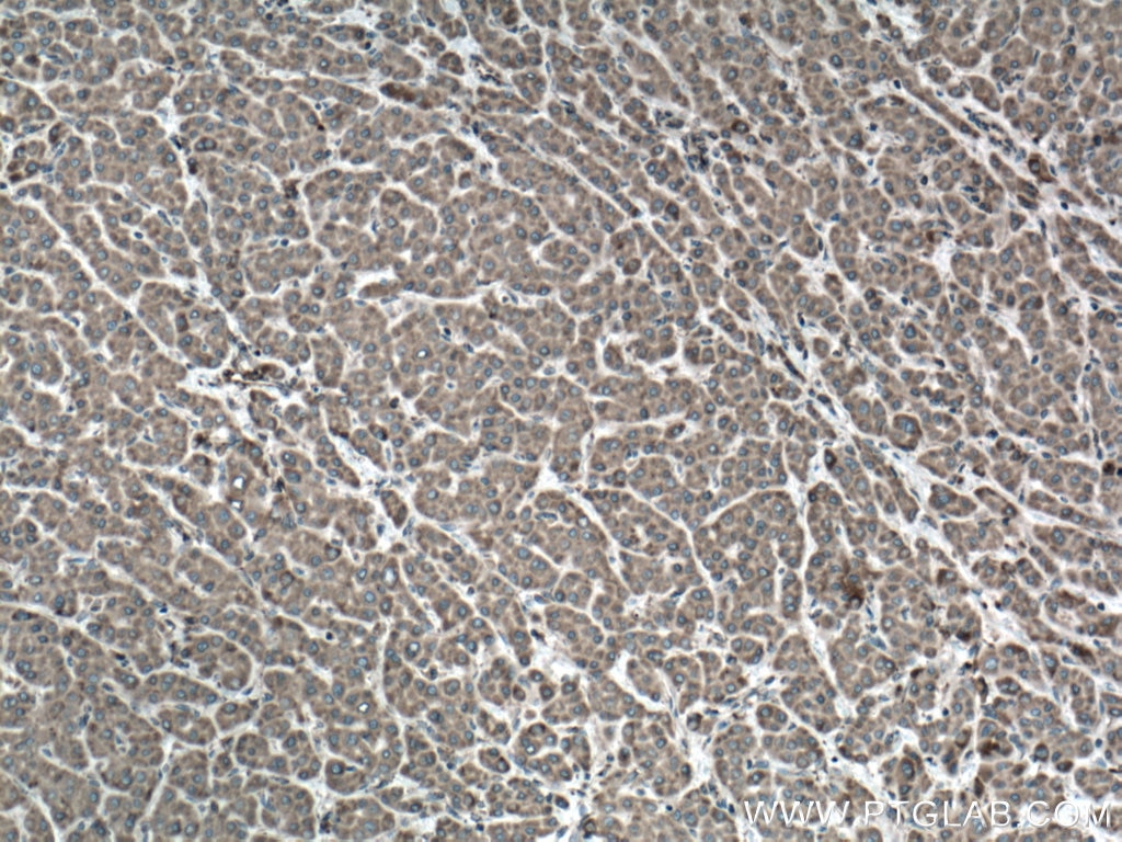 Immunohistochemistry (IHC) staining of human liver cancer tissue using VAPA Polyclonal antibody (15275-1-AP)