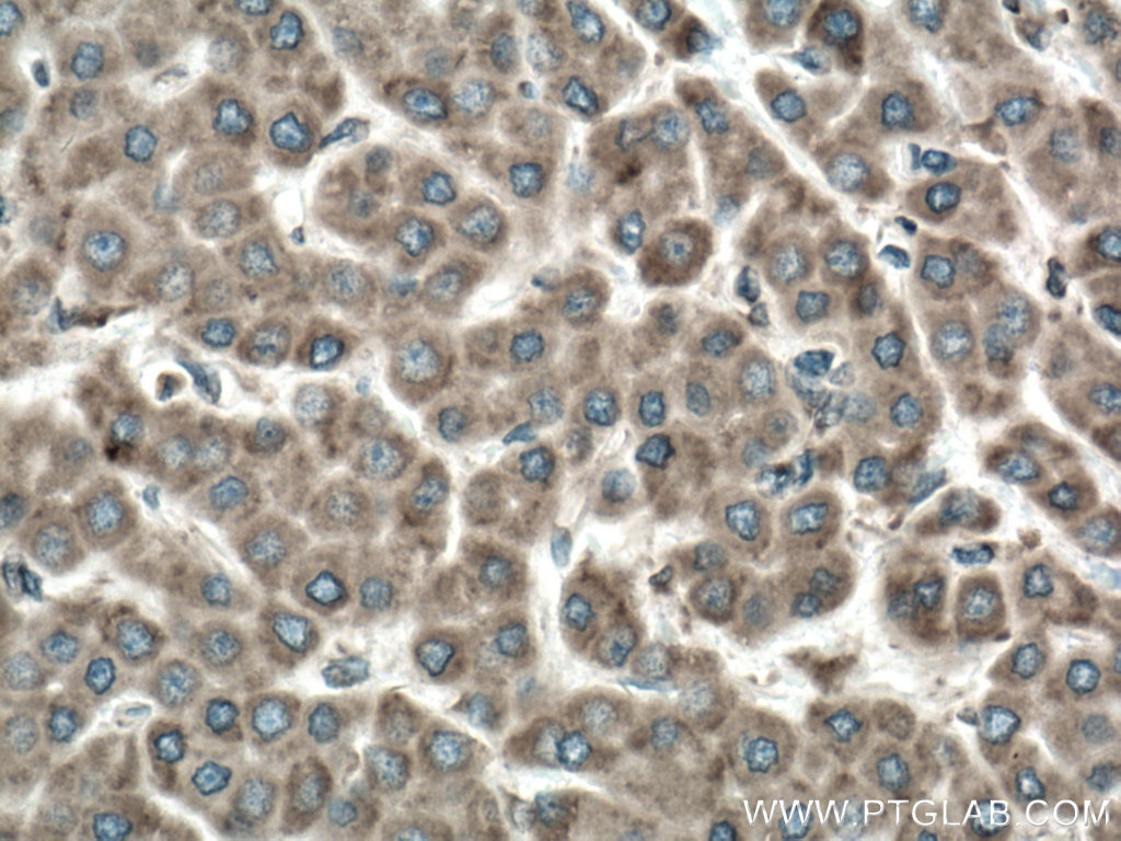 Immunohistochemistry (IHC) staining of human liver cancer tissue using VAPA Polyclonal antibody (15275-1-AP)