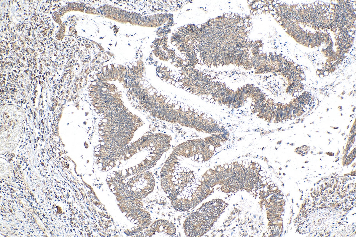 Immunohistochemistry (IHC) staining of human colon cancer tissue using VAPA Polyclonal antibody (15275-1-AP)