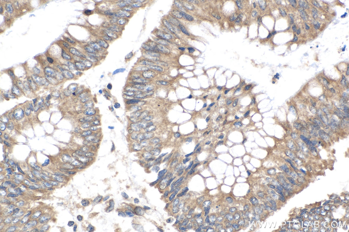 Immunohistochemistry (IHC) staining of human colon cancer tissue using VAPA Polyclonal antibody (15275-1-AP)