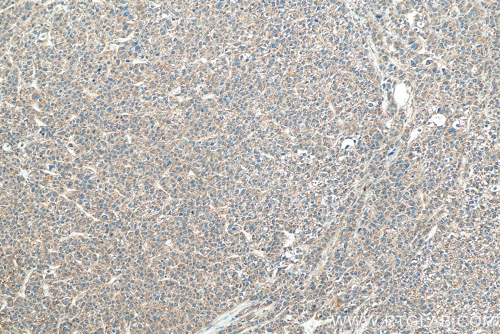 Immunohistochemistry (IHC) staining of human liver cancer tissue using VAPA Monoclonal antibody (67845-1-Ig)