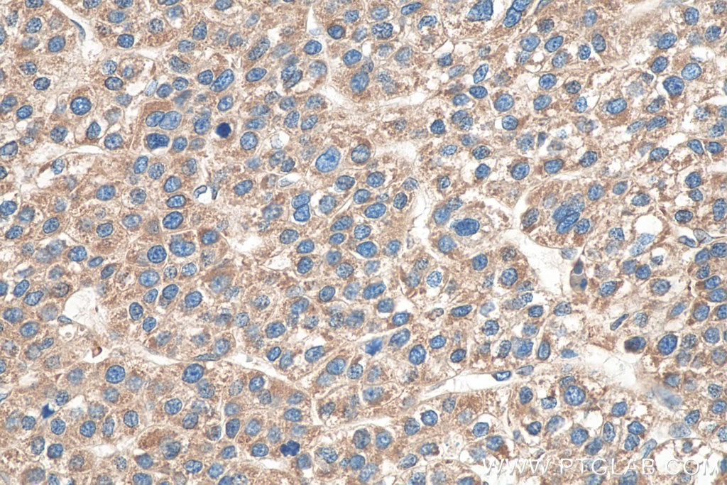 Immunohistochemistry (IHC) staining of human liver cancer tissue using VAPA Monoclonal antibody (67845-1-Ig)