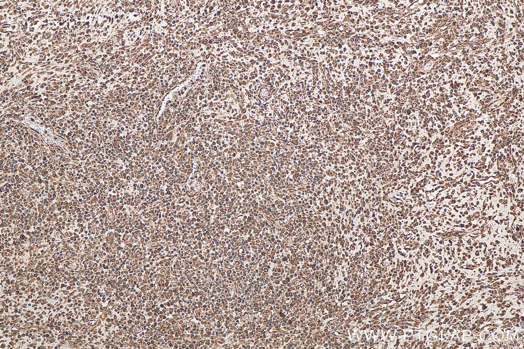 IHC staining of human colon cancer using 67845-1-Ig