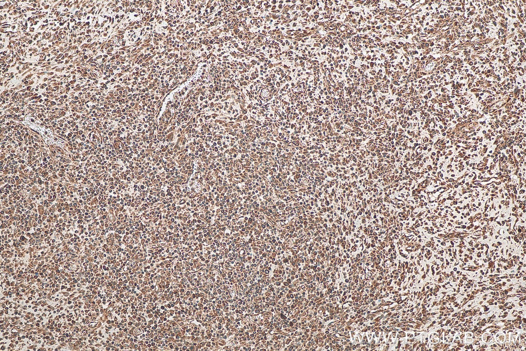 Immunohistochemistry (IHC) staining of human colon cancer tissue using VAPA Monoclonal antibody (67845-1-Ig)