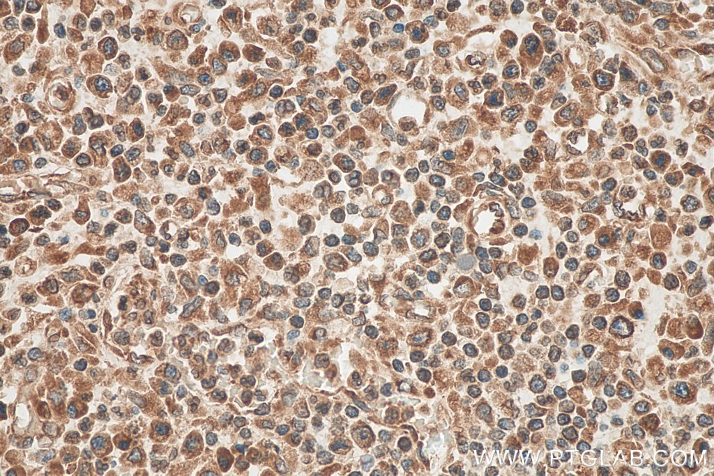 Immunohistochemistry (IHC) staining of human colon cancer tissue using VAPA Monoclonal antibody (67845-1-Ig)