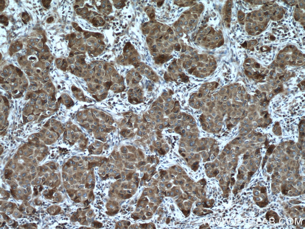 Immunohistochemistry (IHC) staining of human breast cancer tissue using VAPB Polyclonal antibody (14477-1-AP)