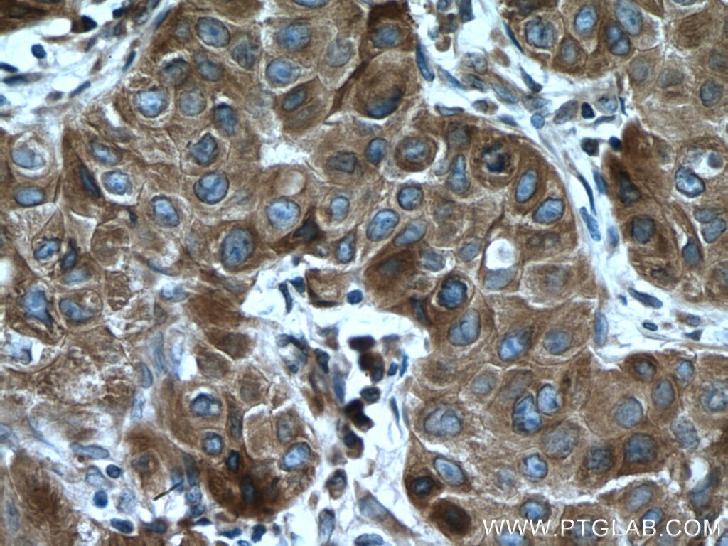 Immunohistochemistry (IHC) staining of human breast cancer tissue using VAPB Polyclonal antibody (14477-1-AP)