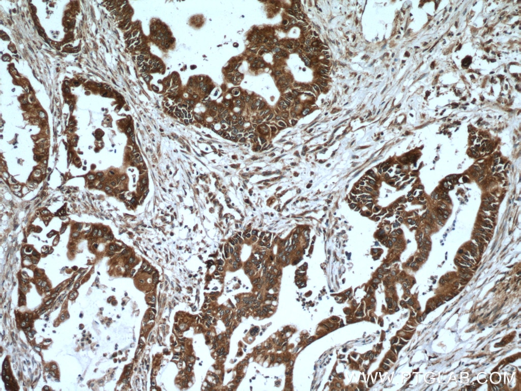 IHC staining of human pancreas cancer using 14477-1-AP