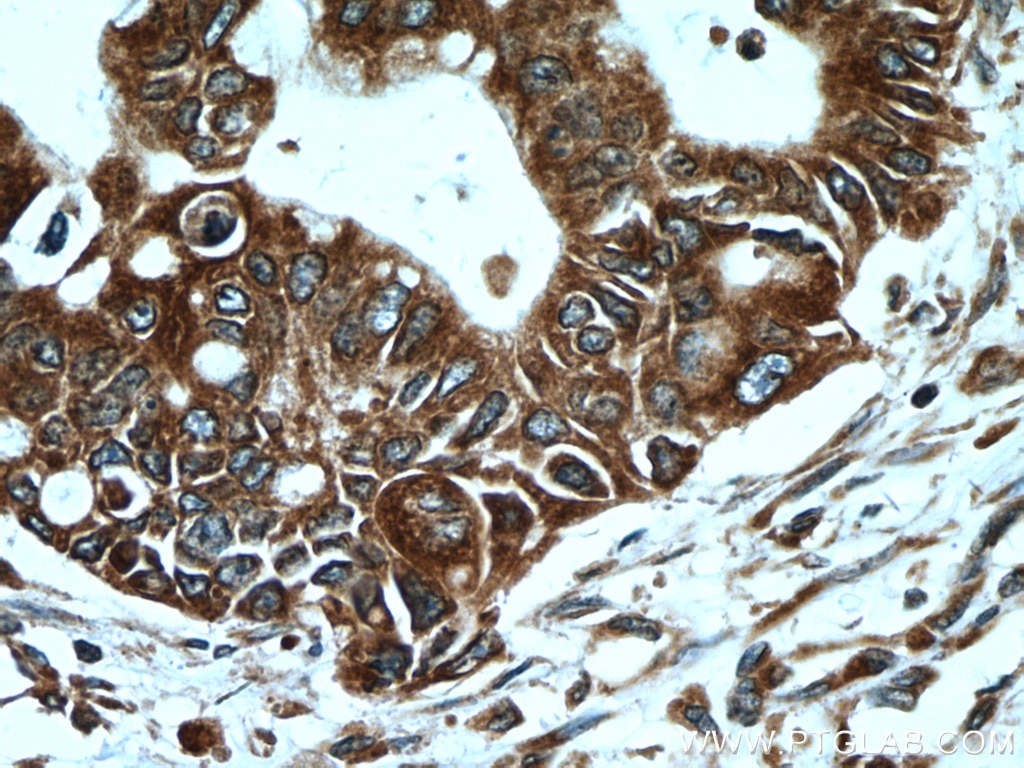 Immunohistochemistry (IHC) staining of human pancreas cancer tissue using VAPB Polyclonal antibody (14477-1-AP)