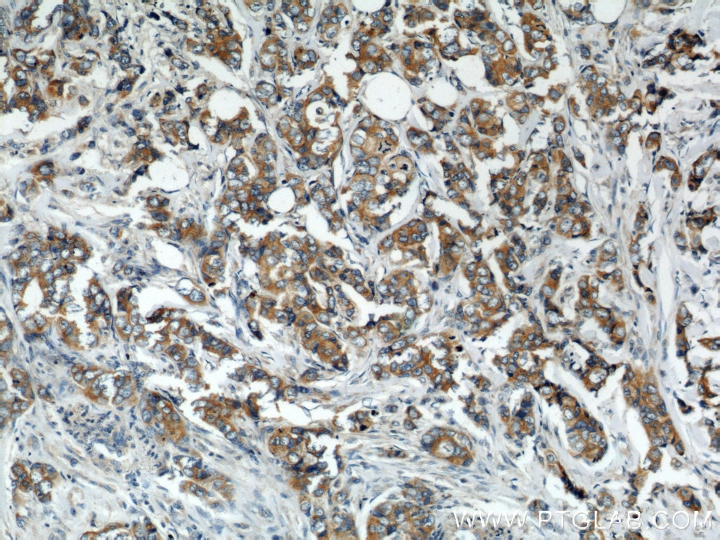 Immunohistochemistry (IHC) staining of human breast cancer tissue using VAPB Polyclonal antibody (14477-1-AP)