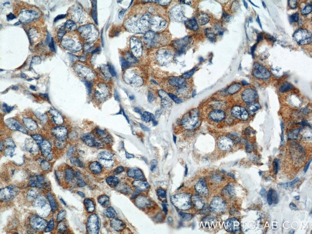 Immunohistochemistry (IHC) staining of human breast cancer tissue using VAPB Polyclonal antibody (14477-1-AP)