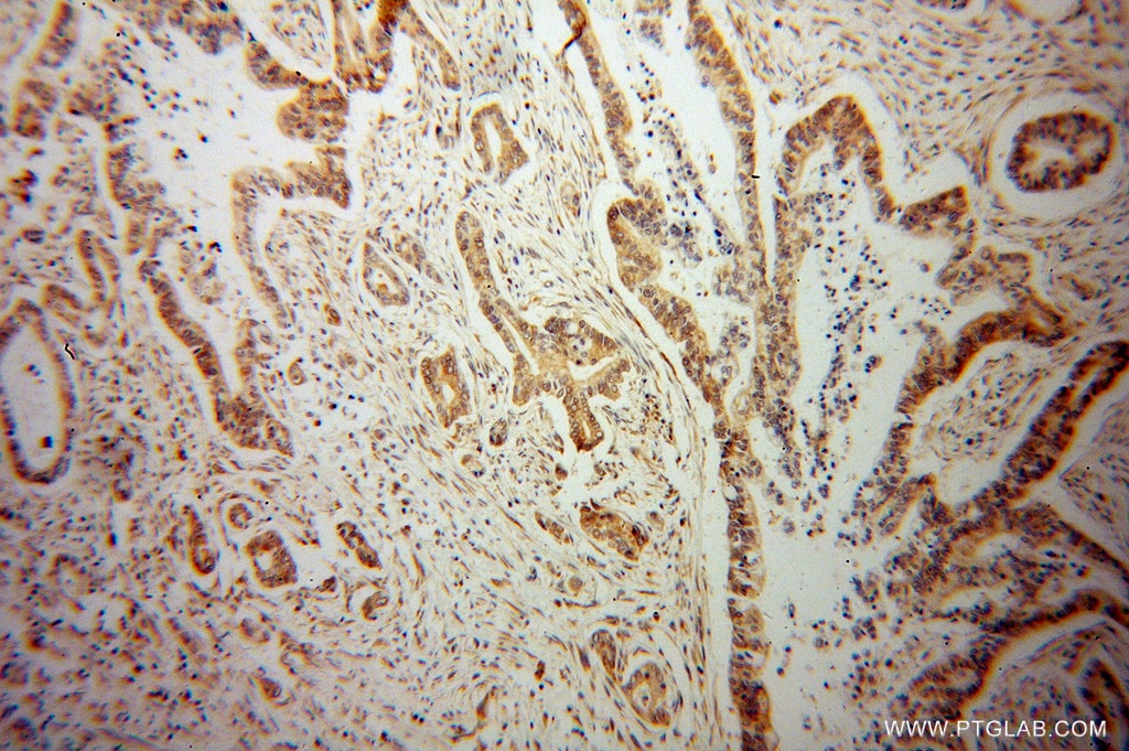 Immunohistochemistry (IHC) staining of human pancreas cancer tissue using VAPB Polyclonal antibody (14477-1-AP)