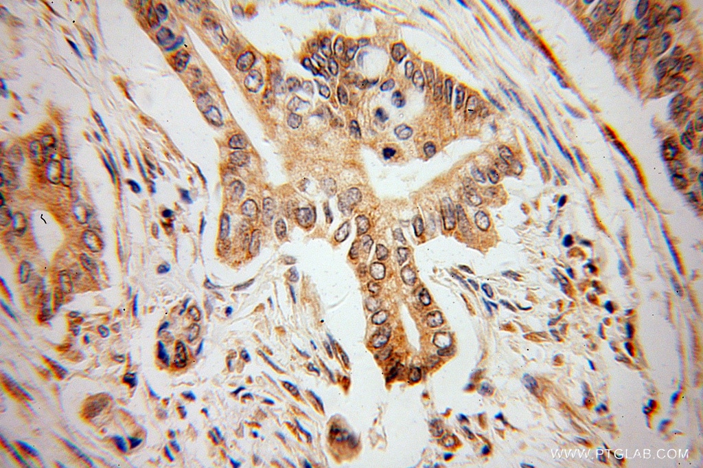 Immunohistochemistry (IHC) staining of human pancreas cancer tissue using VAPB Polyclonal antibody (14477-1-AP)