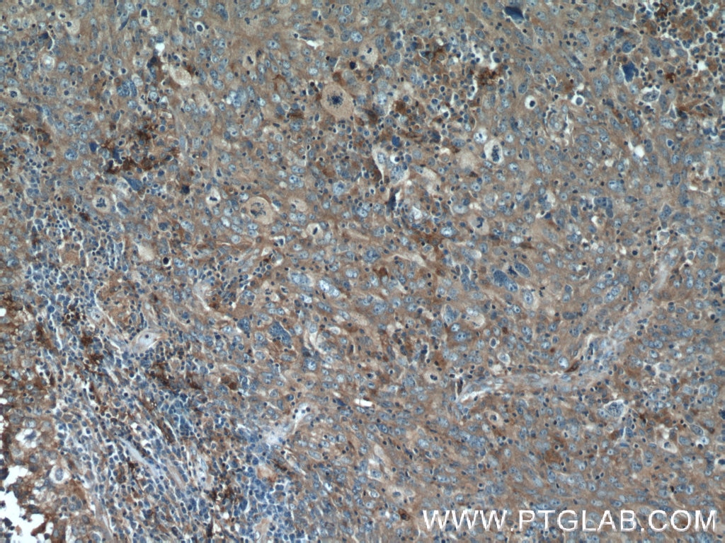 Immunohistochemistry (IHC) staining of human breast cancer tissue using VAPB Monoclonal antibody (66191-1-Ig)