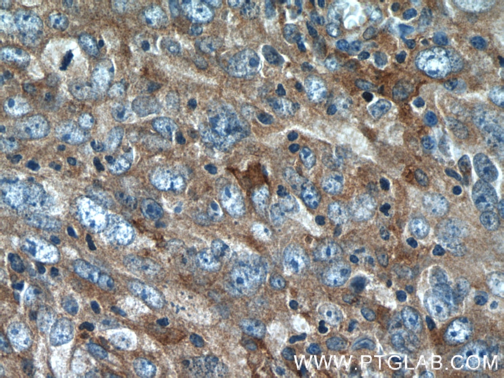 Immunohistochemistry (IHC) staining of human breast cancer tissue using VAPB Monoclonal antibody (66191-1-Ig)