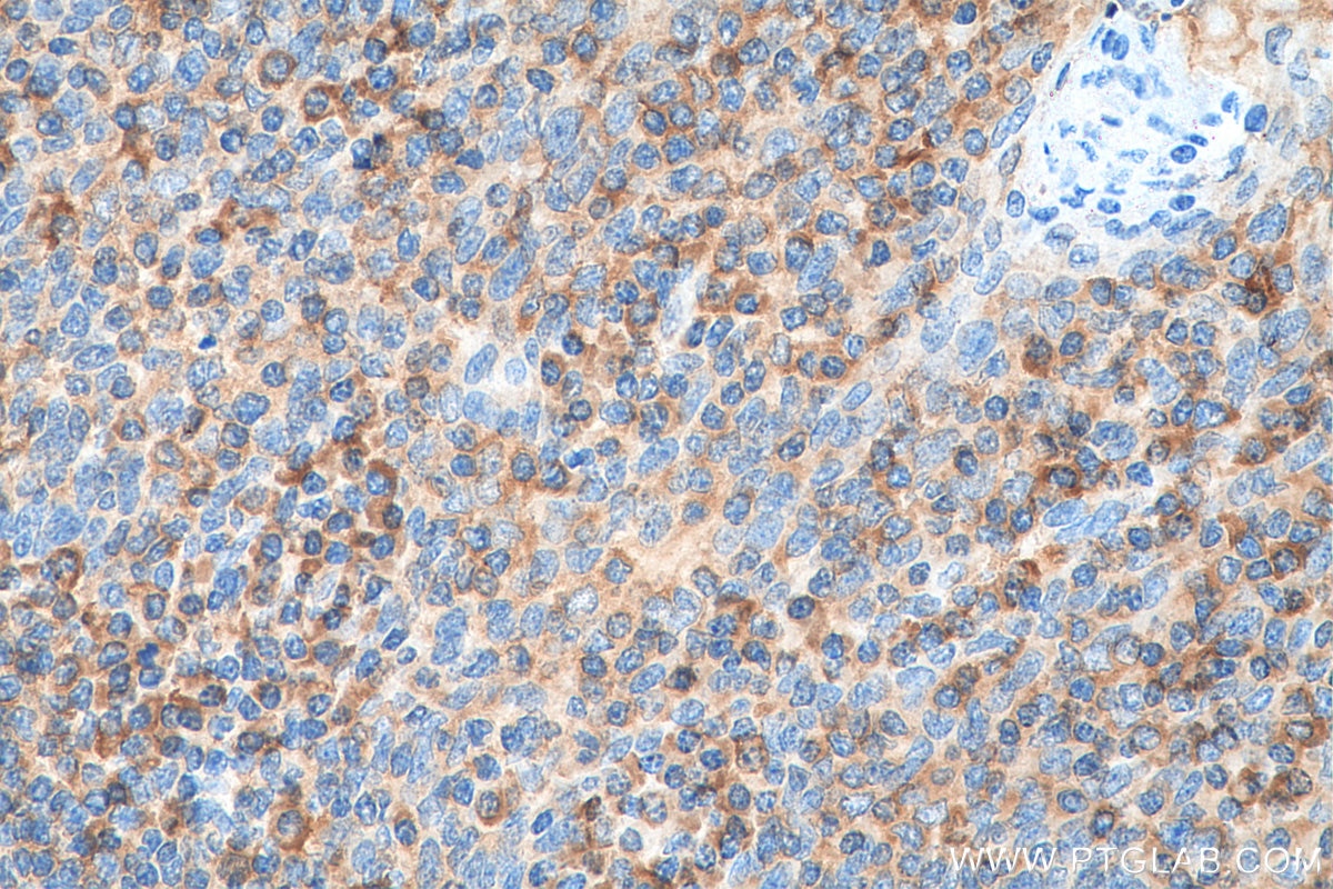Immunohistochemistry (IHC) staining of human tonsillitis tissue using ValRS Polyclonal antibody (15931-1-AP)