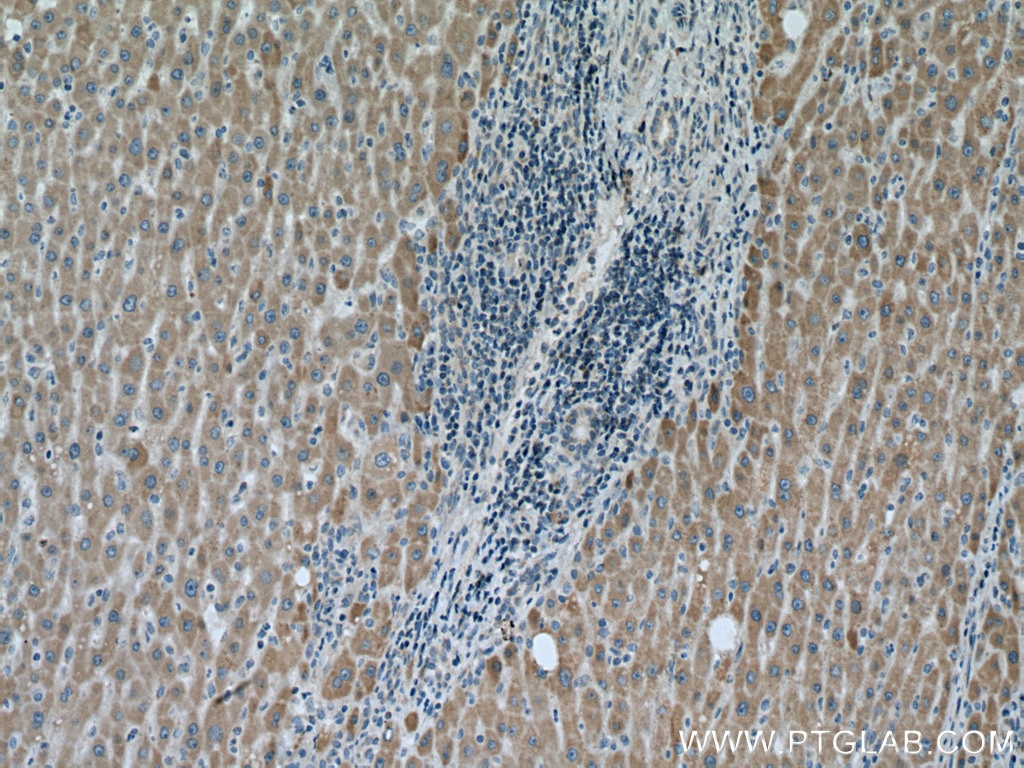 Immunohistochemistry (IHC) staining of human liver cancer tissue using VARS2 Polyclonal antibody (15776-1-AP)