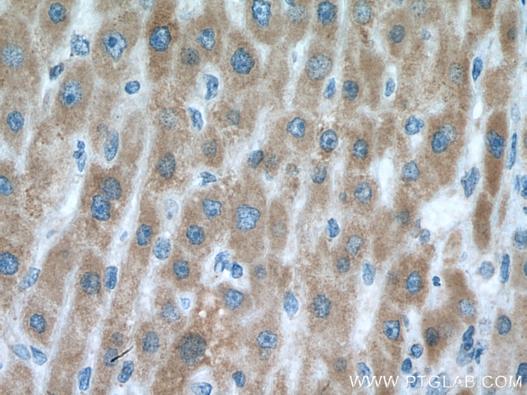 Immunohistochemistry (IHC) staining of human liver cancer tissue using VARS2 Polyclonal antibody (15776-1-AP)