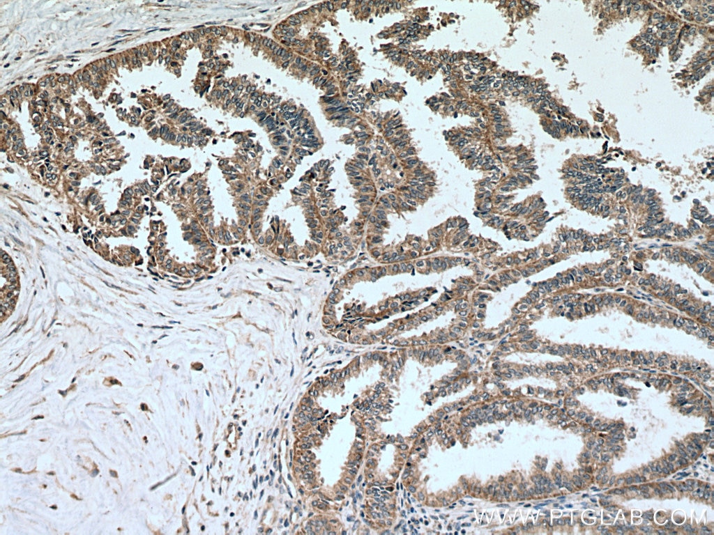 IHC staining of human ovary tumor using 15776-1-AP