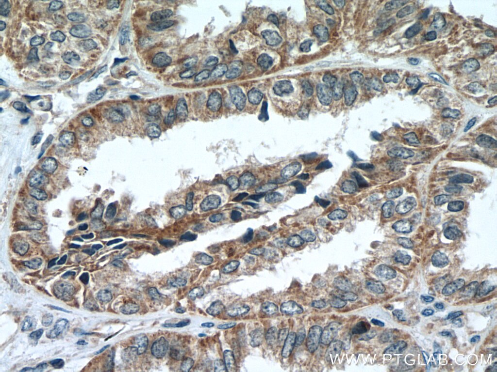 Immunohistochemistry (IHC) staining of human ovary tumor tissue using VARS2 Polyclonal antibody (15776-1-AP)
