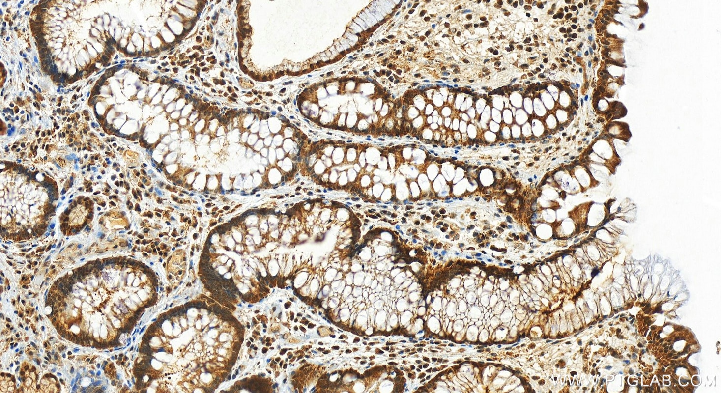 Immunohistochemistry (IHC) staining of human stomach cancer tissue using VASH2 Polyclonal antibody (13303-1-AP)
