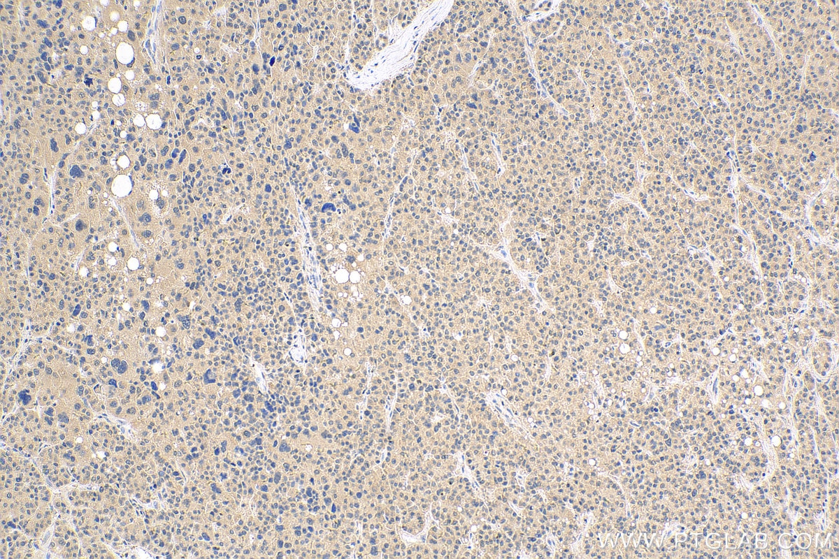 Immunohistochemistry (IHC) staining of human liver cancer tissue using VASH2 Polyclonal antibody (13303-1-AP)