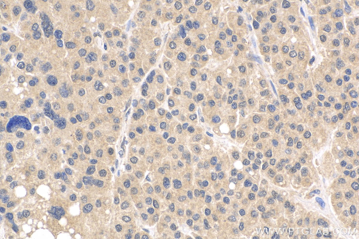 Immunohistochemistry (IHC) staining of human liver cancer tissue using VASH2 Polyclonal antibody (13303-1-AP)