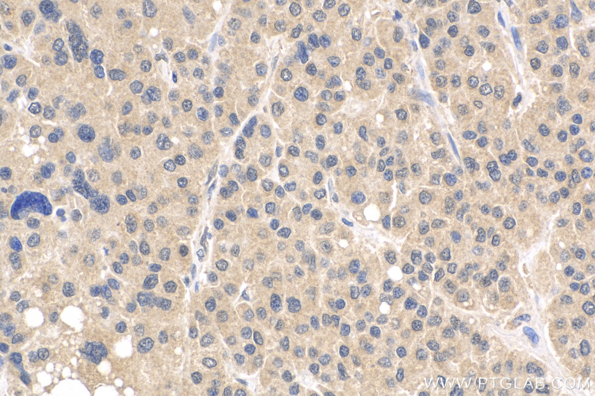 Immunohistochemistry (IHC) staining of human liver cancer tissue using VASH2 Polyclonal antibody (13303-1-AP)