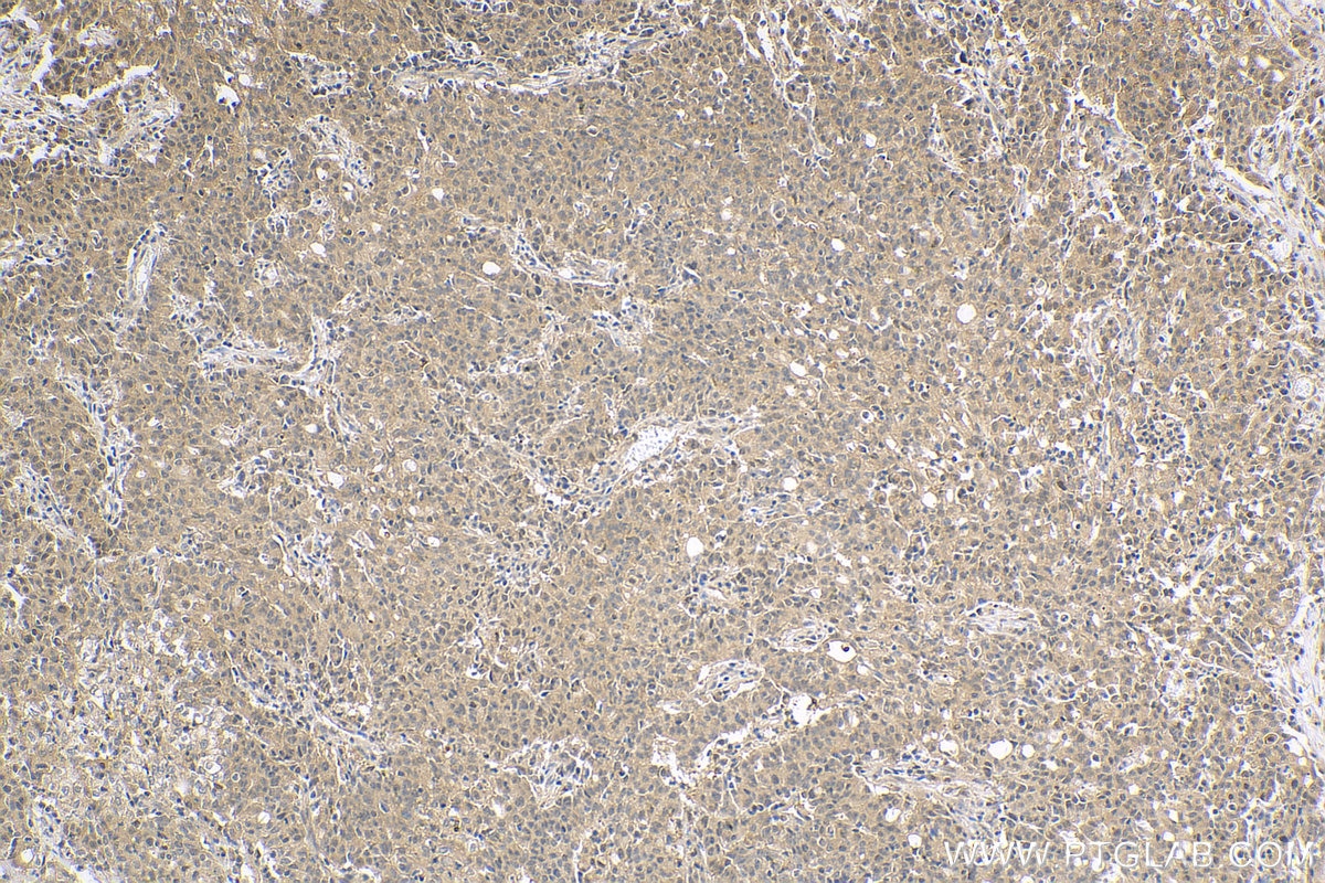 Immunohistochemistry (IHC) staining of human stomach cancer tissue using VASH2 Polyclonal antibody (13303-1-AP)