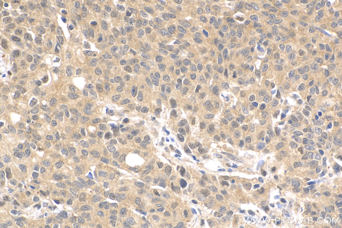 Immunohistochemistry (IHC) staining of human stomach cancer tissue using VASH2 Polyclonal antibody (13303-1-AP)