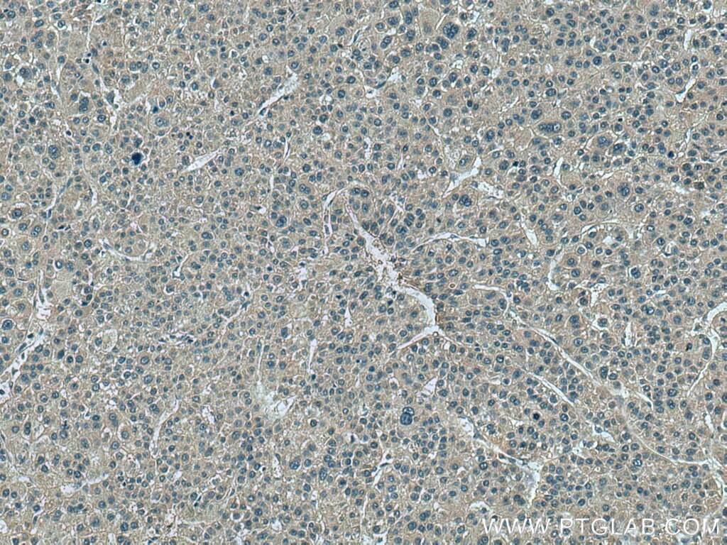 Immunohistochemistry (IHC) staining of human liver cancer tissue using VASH2 Monoclonal antibody (67753-1-Ig)