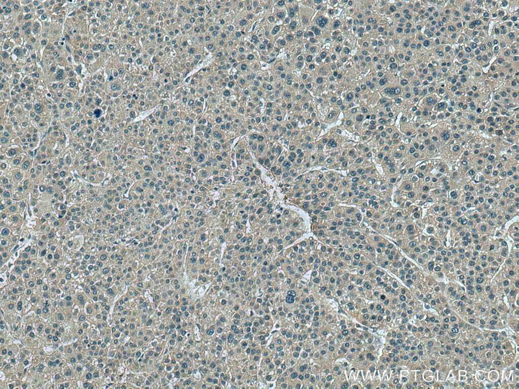 IHC staining of human liver cancer using 67753-1-Ig