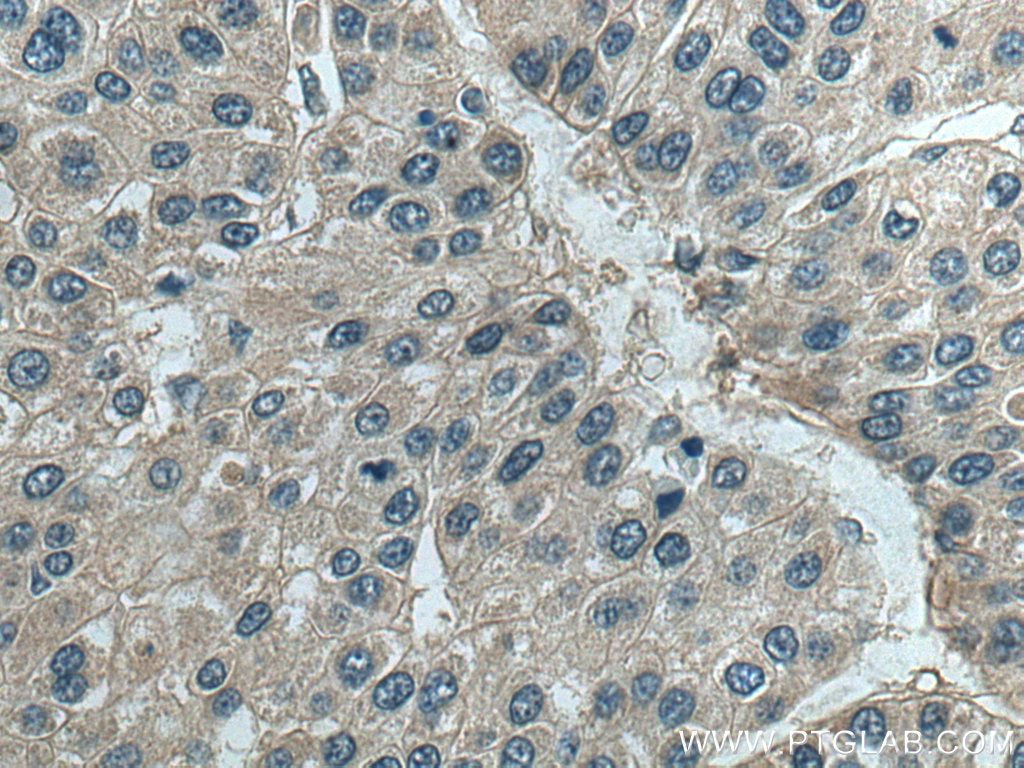 IHC staining of human liver cancer using 67753-1-Ig
