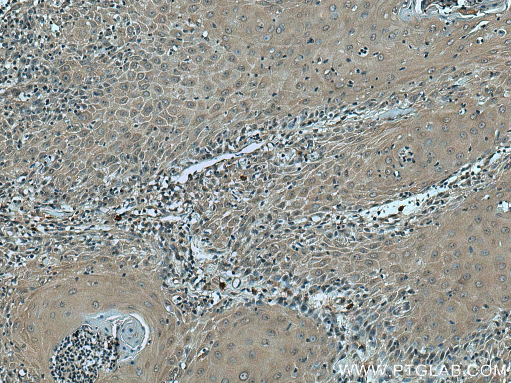 Immunohistochemistry (IHC) staining of human skin cancer tissue using VASH2 Monoclonal antibody (67753-1-Ig)