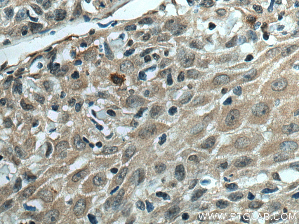 IHC staining of human skin cancer using 67753-1-Ig
