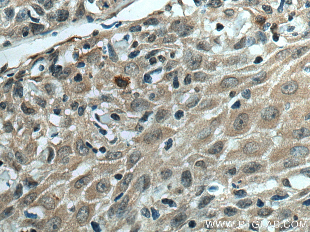 Immunohistochemistry (IHC) staining of human skin cancer tissue using VASH2 Monoclonal antibody (67753-1-Ig)
