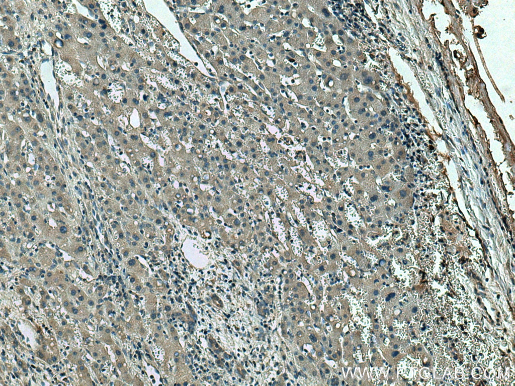 Immunohistochemistry (IHC) staining of human liver cancer tissue using VASH2 Monoclonal antibody (67753-1-Ig)