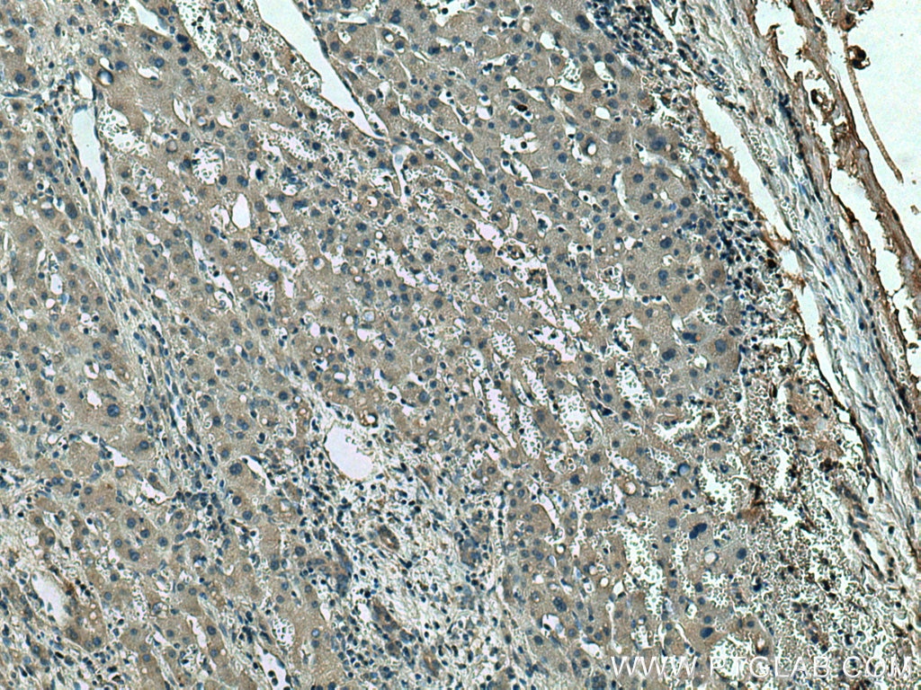 IHC staining of human liver cancer using 67753-1-Ig