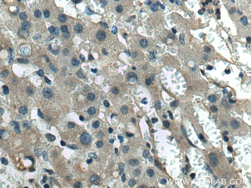 Immunohistochemistry (IHC) staining of human liver cancer tissue using VASH2 Monoclonal antibody (67753-1-Ig)