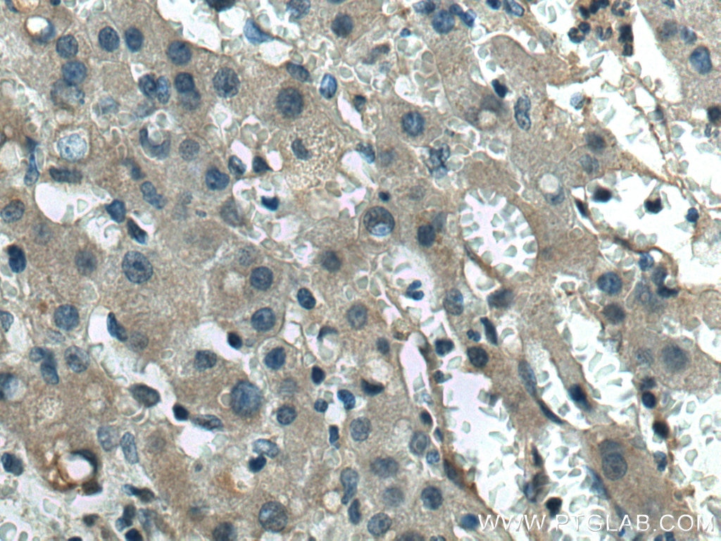 IHC staining of human liver cancer using 67753-1-Ig