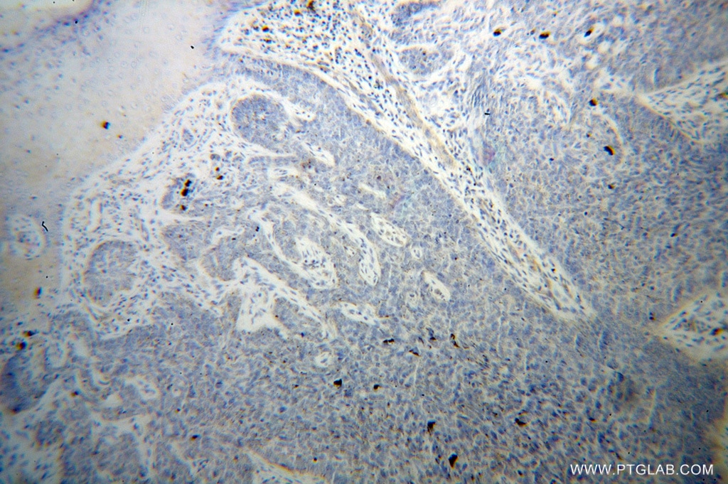 IHC staining of human skin cancer using 13472-1-AP