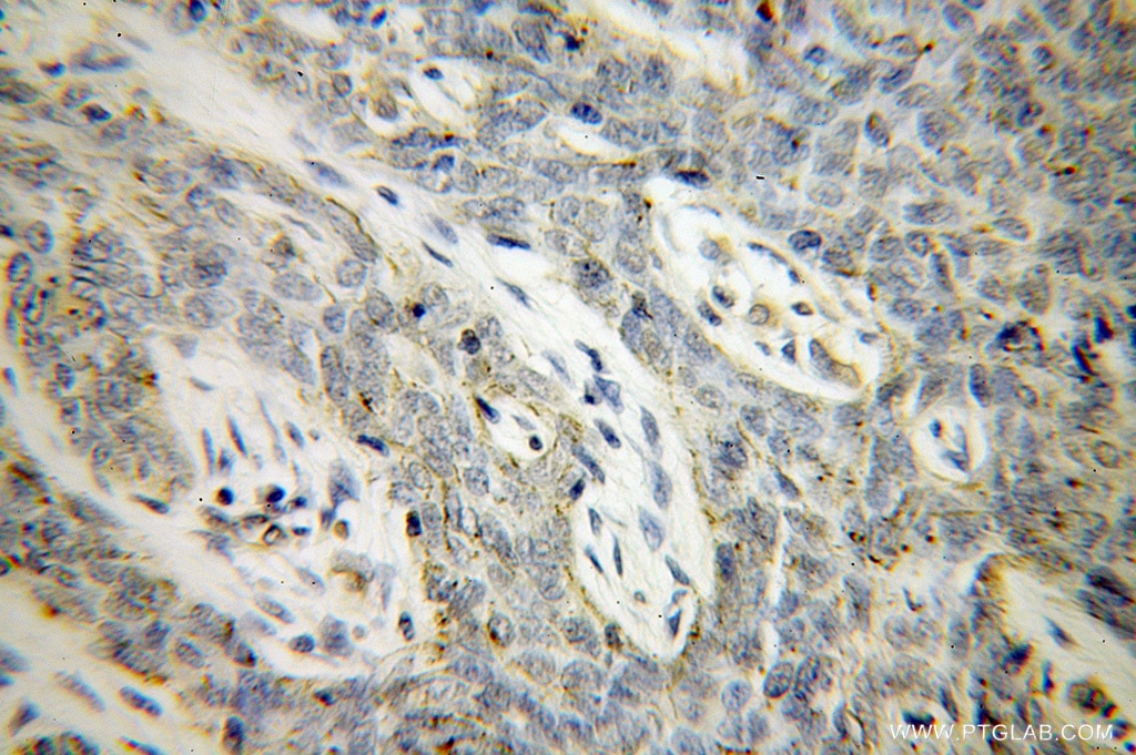 Immunohistochemistry (IHC) staining of human skin cancer tissue using VASP Polyclonal antibody (13472-1-AP)