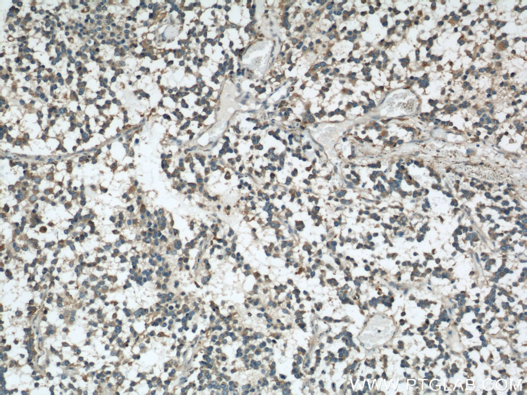 Immunohistochemistry (IHC) staining of human gliomas tissue using VAT1 Polyclonal antibody (22016-1-AP)