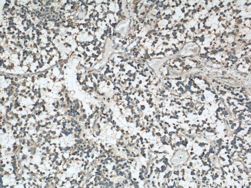 Immunohistochemistry (IHC) staining of human gliomas tissue using VAT1 Polyclonal antibody (22016-1-AP)
