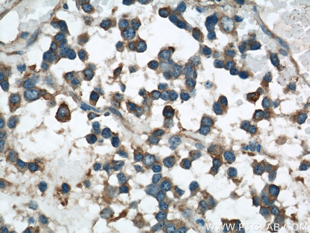 Immunohistochemistry (IHC) staining of human gliomas tissue using VAT1 Polyclonal antibody (22016-1-AP)