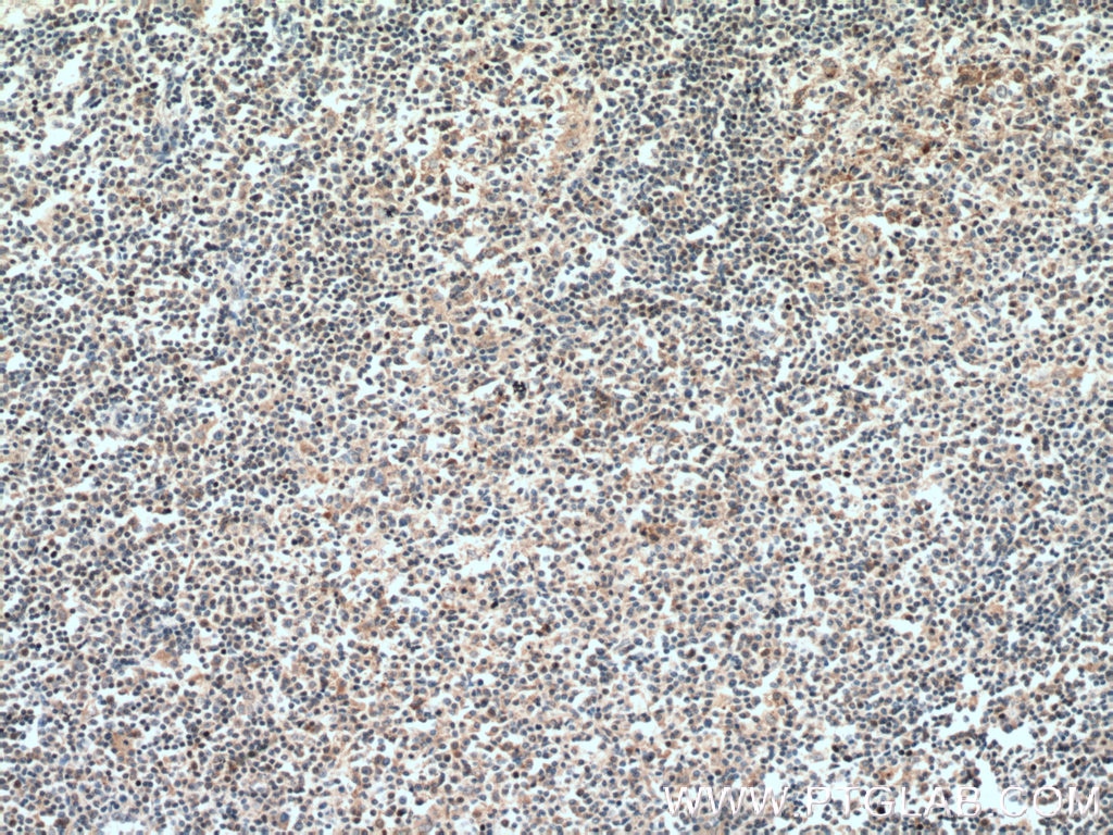 Immunohistochemistry (IHC) staining of human lymphoma tissue using VAV1 Polyclonal antibody (16364-1-AP)