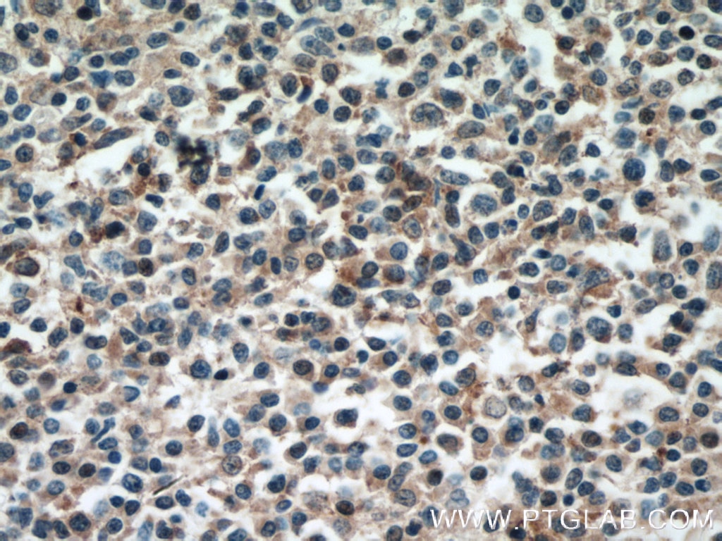 Immunohistochemistry (IHC) staining of human lymphoma tissue using VAV1 Polyclonal antibody (16364-1-AP)